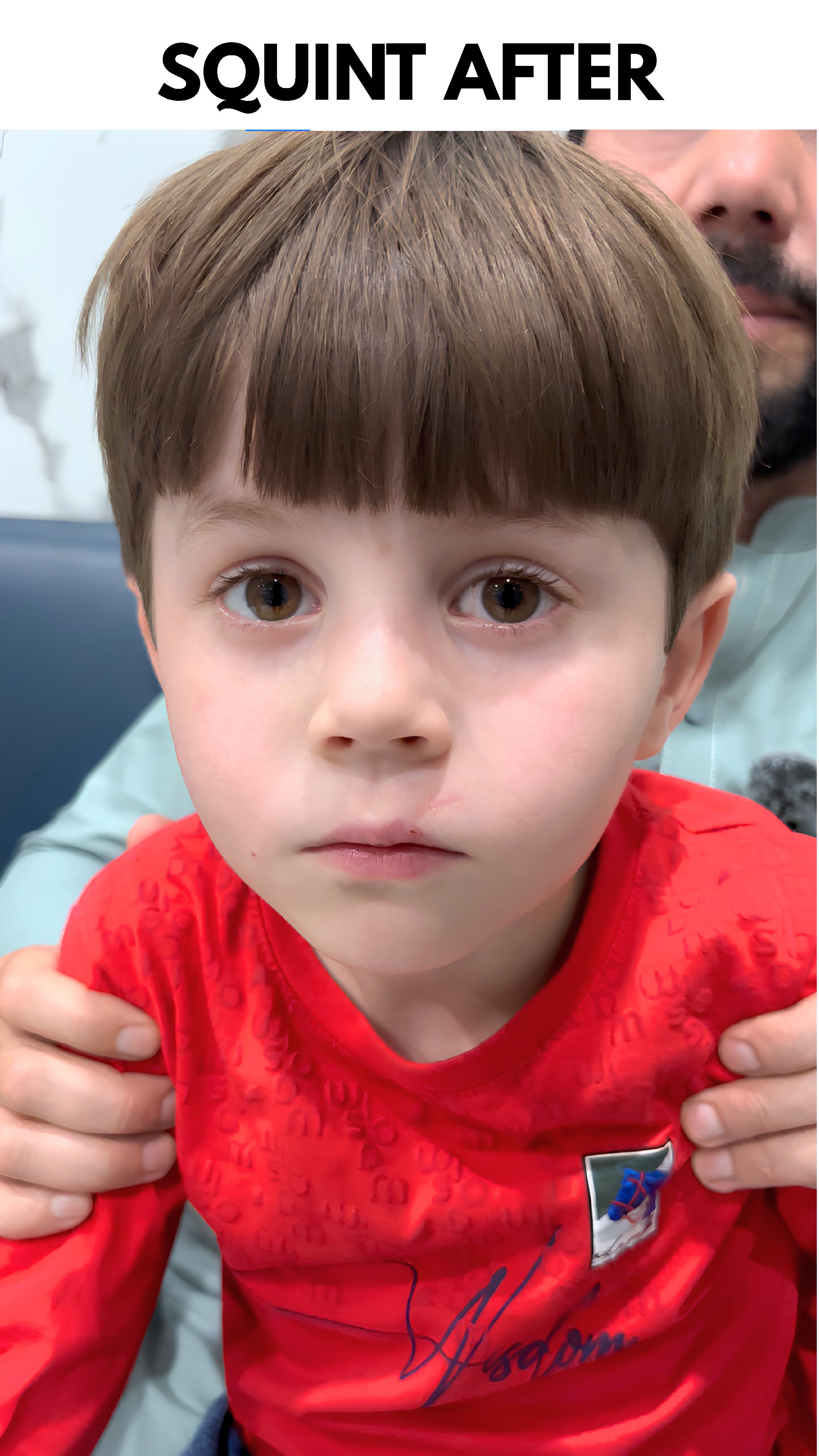 After surgery: Squint Surgery
