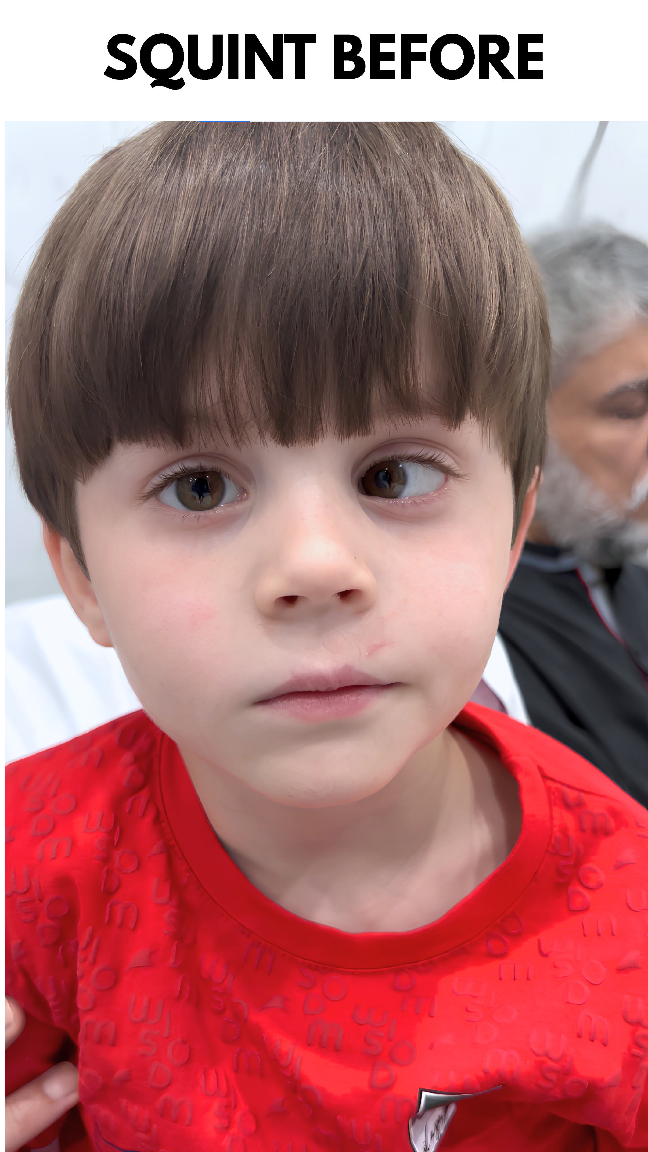 Before surgery: Squint Surgery